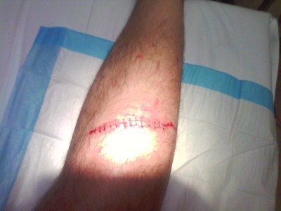 All stitched up